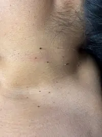 Image of huidoneffenheden