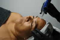 SkinPen microneedling behandeling bij MartensSkin